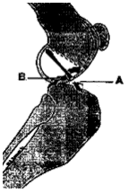 Ruptured ligaments